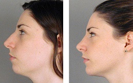 Chin Augmentation before and after