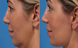 Chin Augmentation before and after