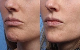 Chin Augmentation before and after