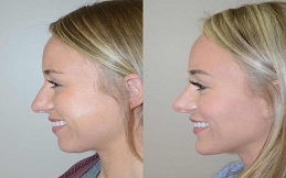 Chin Augmentation before and after