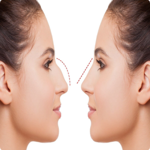 Closed Rhinoplasty Cost in Dubai