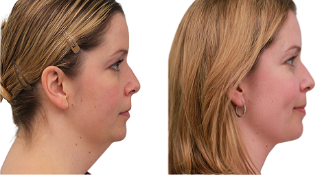 Double Chin Liposuction Before and After