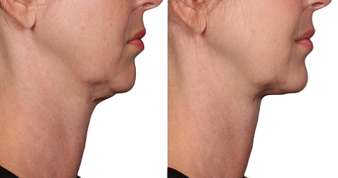 Double Chin Liposuction Before and After