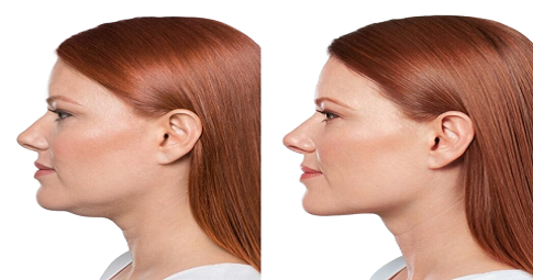 Double Chin Liposuction Before and After