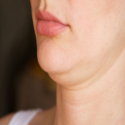 Double Chin Liposuction in Dubai