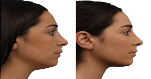 Double Chin Liposuction Before and After