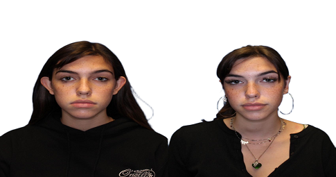Ear reshaping before and after