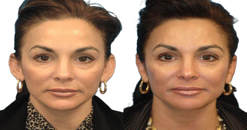 Ear reshaping before and after