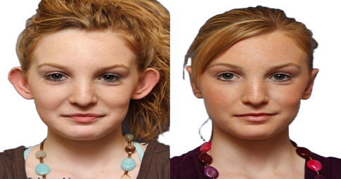 Ear reshaping before and after