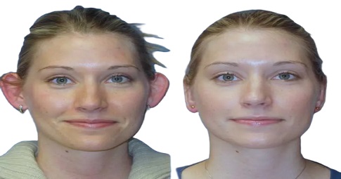 Ear reshaping before and after