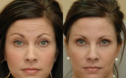 Forehead Lift Surgery before and after