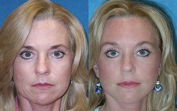 Forehead Lift Surgery before and after