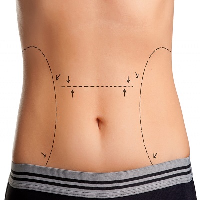 High-Definition Liposculpture in Dubai