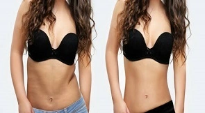 BodyTite Liposuction in Dubai