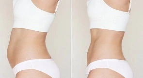 BodyTite Liposuction in Dubai