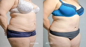 BodyTite Liposuction in Dubai