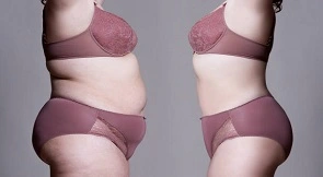 BodyTite Liposuction in Dubai