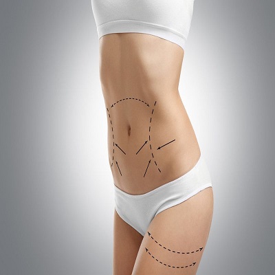 Bodytite Liposuction in Dubai