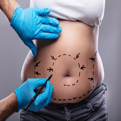 Bodytite Liposuction in Dubai