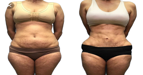 Bodytite Liposuction Before and After