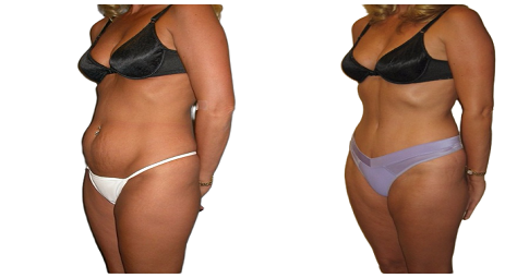 Bodytite Liposuction Before and After