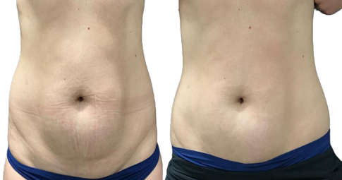 Bodytite Liposuction Before and After
