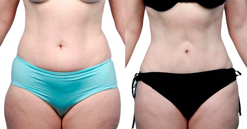 Bodytite Liposuction Before and After