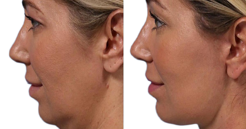 Chin Augmentation Before and After