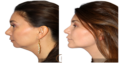 Chin Augmentation Before and After