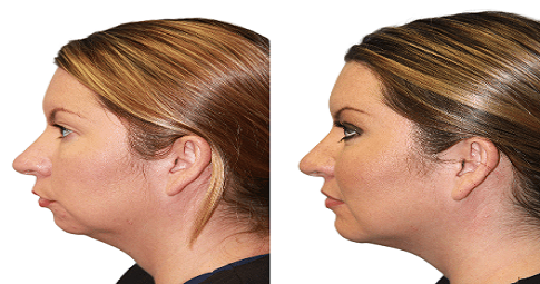 Chin Augmentation Before and After