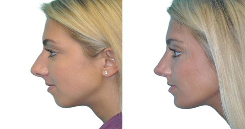 Chin Reduction Before and After