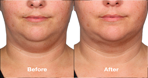 Chin Reduction Before and After