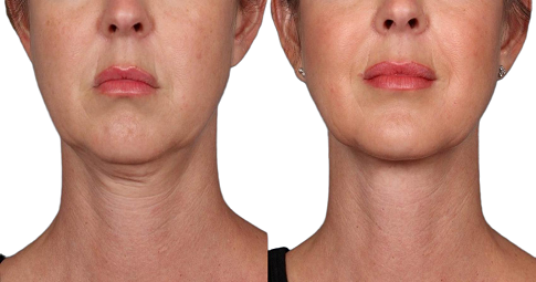 Chin Reduction Before and After