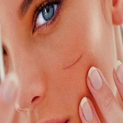 Facial Scar Revision in Dubai