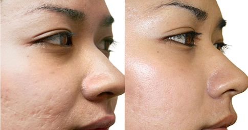 Facial Scar Revision Before and After