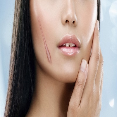 Facial Scar Revision in Dubai