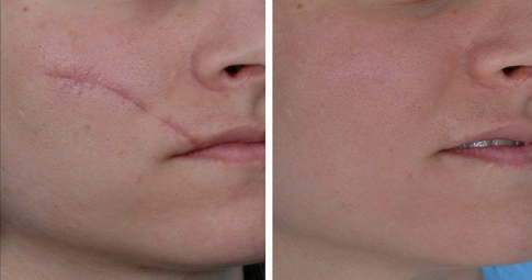 Facial Scar Revision Before and After