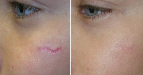 Facial Scar Revision Before and After