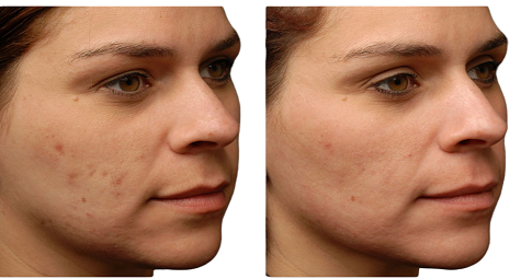 Facial Scar Revision Before and After