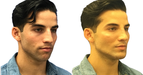 Jawline Surgery Before and After
