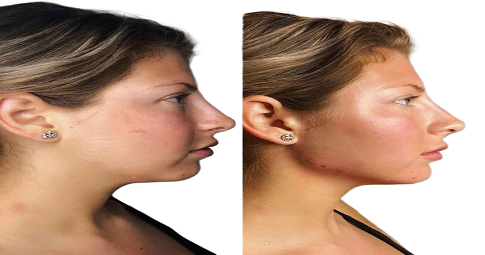 Jawline Surgery Before and After