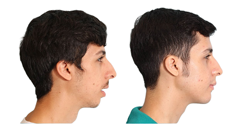 Jawline Surgery Before and After