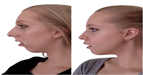 Jawline Surgery Before and After