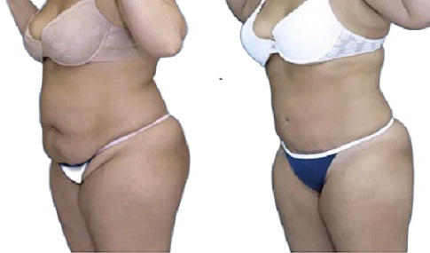 Vaser Quad Liposuction Before and After