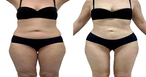 Vaser Quad Liposuction Before and After