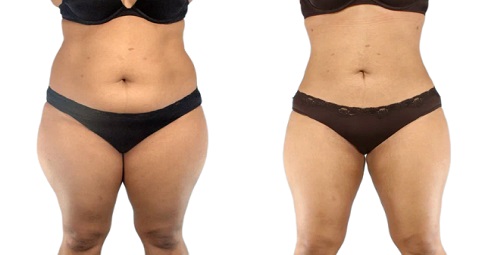 Vaser Quad Liposuction Before and After