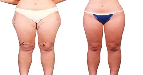 Vaser Quad Liposuction Before and After