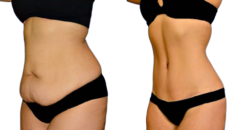 Waist Scuplting Before and After