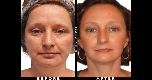 Brow Lift Surgery before and after