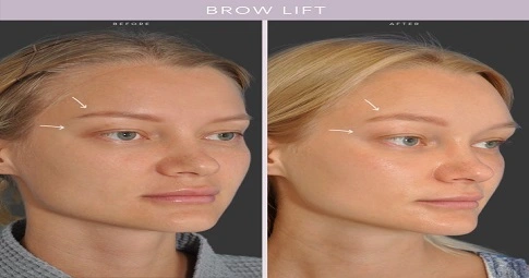 Brow Lift Surgery Before and After